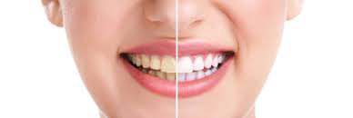 Teeth Whitening